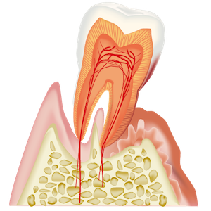 歯周病菌によって歯槽骨が溶かされた状態のイラスト