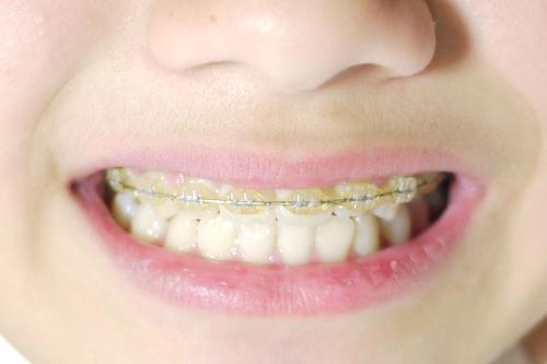矯正歯科の２期治療について