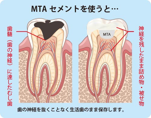 歯の神経が残せる場合：歯髄保存療法